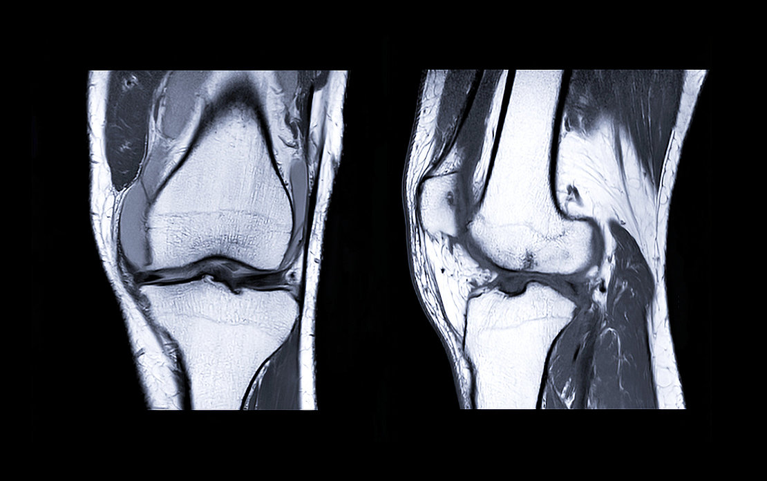 MRI Knee joint 3view
